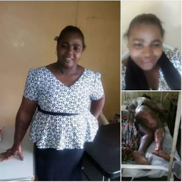 Woman Celebrates One Year Anniversary After Surviving Fire Tragedy In Her House. Photos